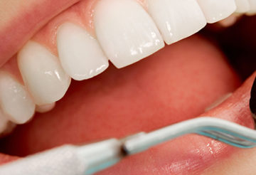 Blanchiment et implants dentaires