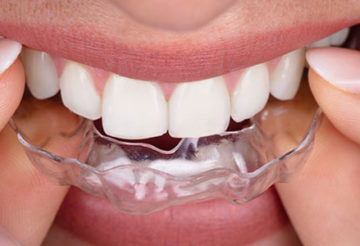 Comment fonctionne le système d'aligners transparents