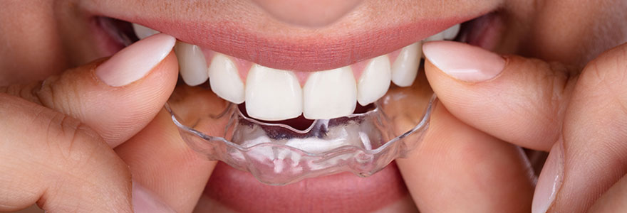 Comment fonctionne le système d'aligners transparents