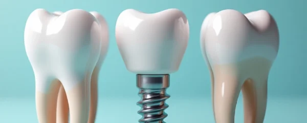 ou-trouver-des-implants-dentaires-de-qualite-a-prix-abordables-en-france